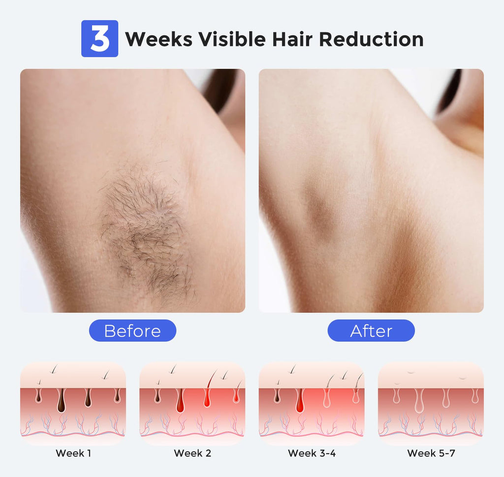 Smart Permanent IPL Laser Hair Removal for Woman and Men, Painless Sapphire Ice-Cooling, Alternative to Salon, Bikini