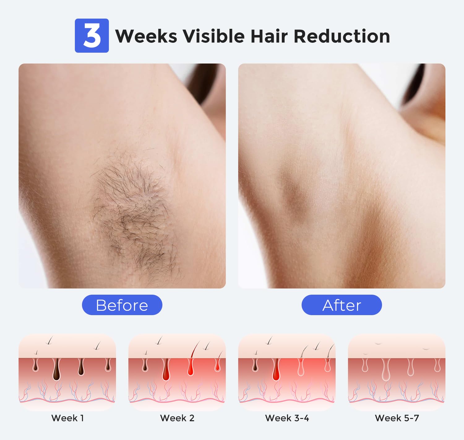 Smart Permanent IPL Laser Hair Removal for Woman and Men, Painless Sapphire Ice-Cooling, Alternative to Salon, Bikini