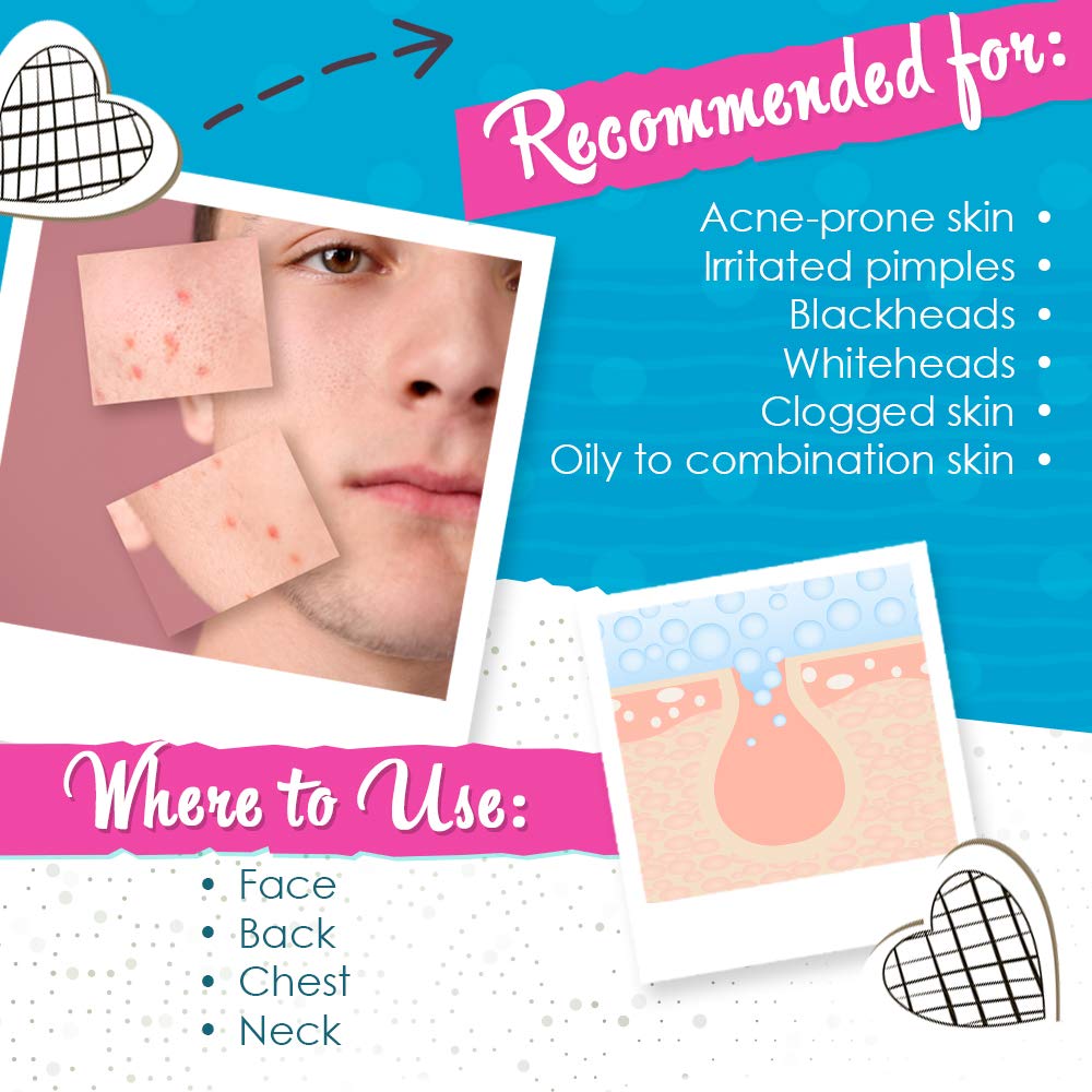 Acne Drying Lotion, Instant Pimple Treatment, 1oz x 2Pack