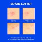 Right Away Thincognito Invisible Spot Patch - Absorbing Hydrocolloid Pimple Patch for Face, Blemishes, Zits, Acne