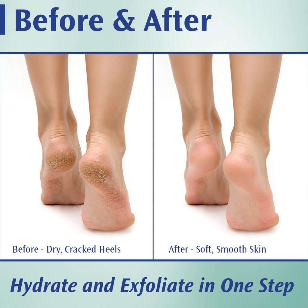 Podiatrists' Choice 20% Urea Callus Control Foot Cream, 4 oz | Extra-strength 20% urea exfoliates and moisturizes