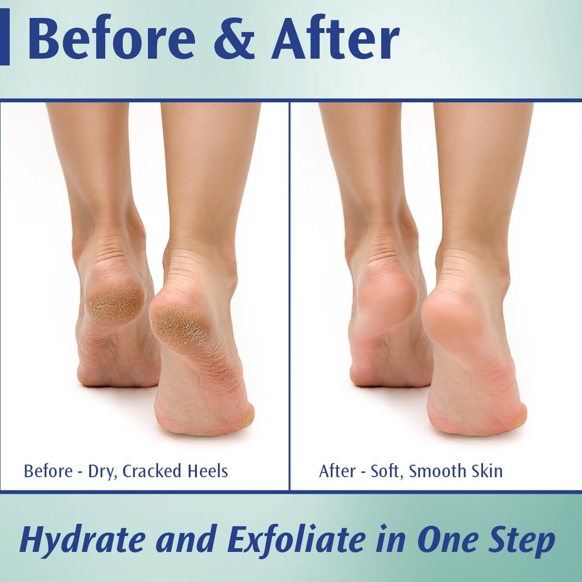 Podiatrists' Choice 20% Urea Callus Control Foot Cream, 4 oz | Extra-strength 20% urea exfoliates and moisturizes