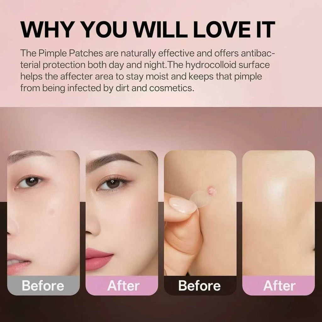 Microdart Acne Patches 2-in-1 Hydrocolloid, Invisible Spot Treatment for Men & Women, All Skin Types