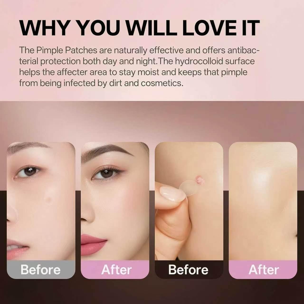 Microdart Acne Patches 2-in-1 Hydrocolloid, Invisible Spot Treatment for Men & Women, All Skin Types