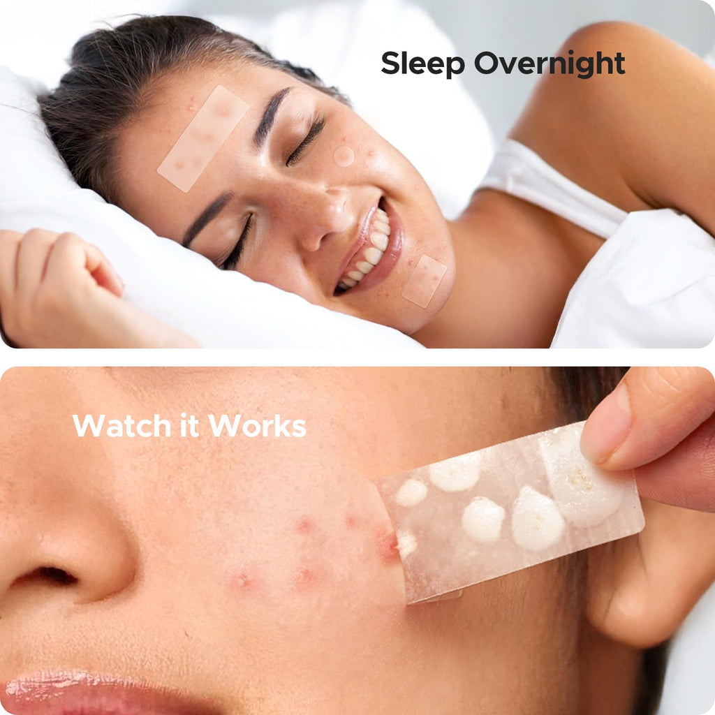 Large Pimple Patches for Face & Body Zit Breakouts, 7 Sizes 302 Count