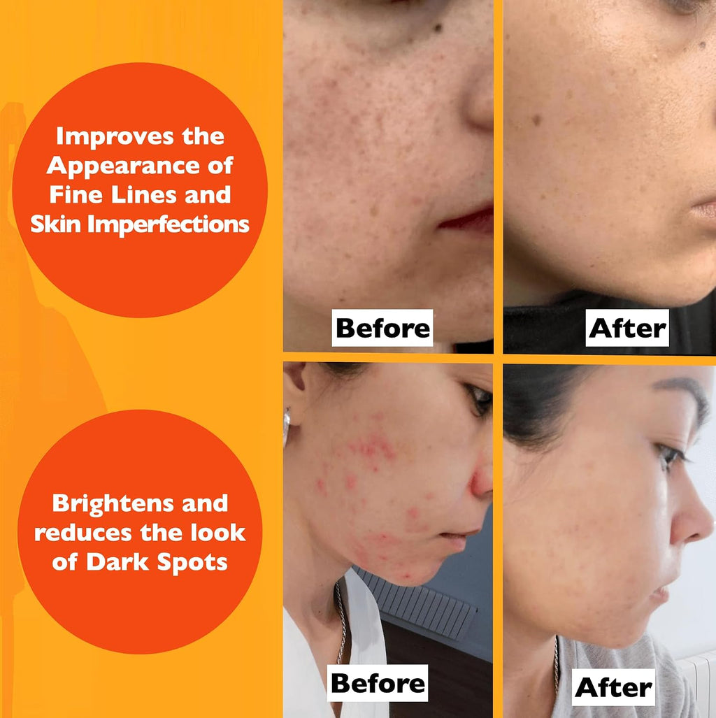 Vitamin C Serum For Face – Anti Aging Face Serum with Vitamin C, Hyaluronic Acid, Vitamin E. Brightening Formula.