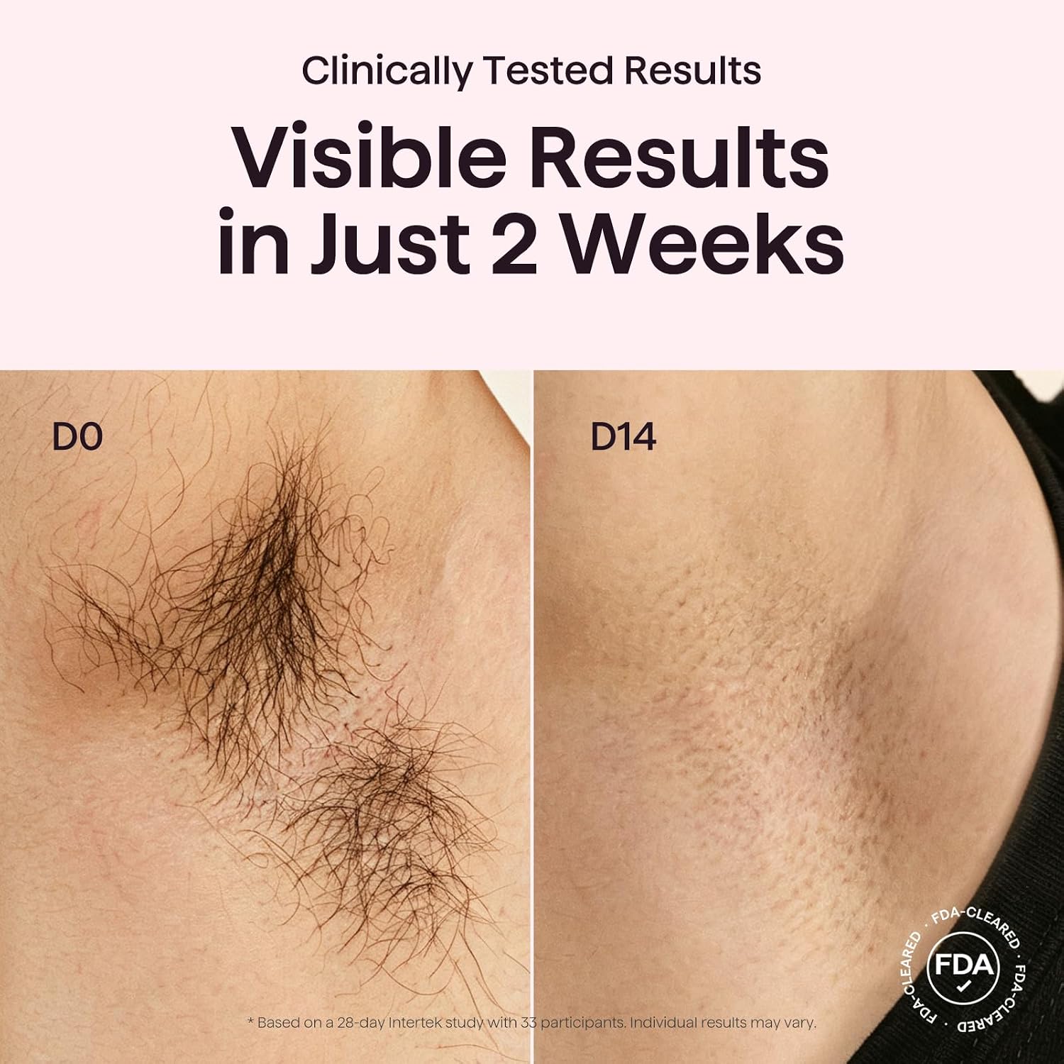 IPL Laser Hair Removal,Bare It with Precision Roller for Full Body | Long-Lasting & Painless, 24J Dual-Pulse & Ice