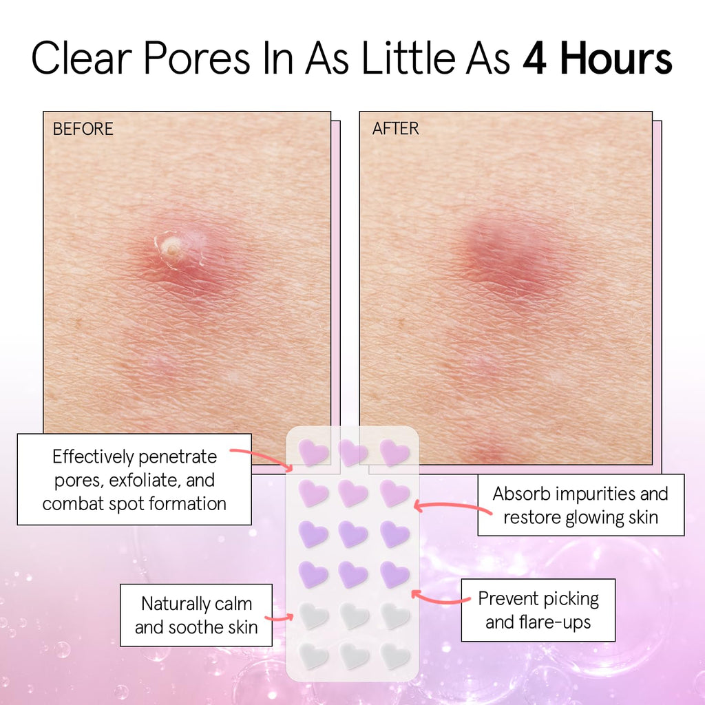 Award Winning Pore Strip - Pimple Patches for Face