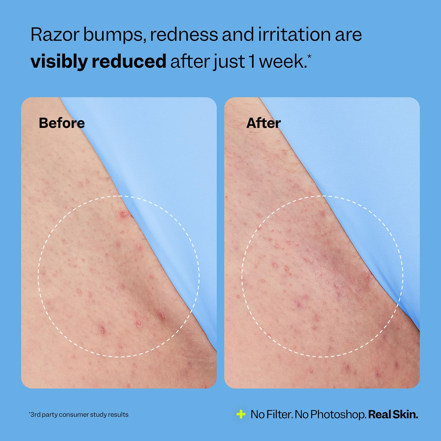 Smoothing Solution Ingrown Hair Treatment (1.69 oz) - Smooth, Relieve, Soften Skin - 360 Roller - BHA, AHA, PHA