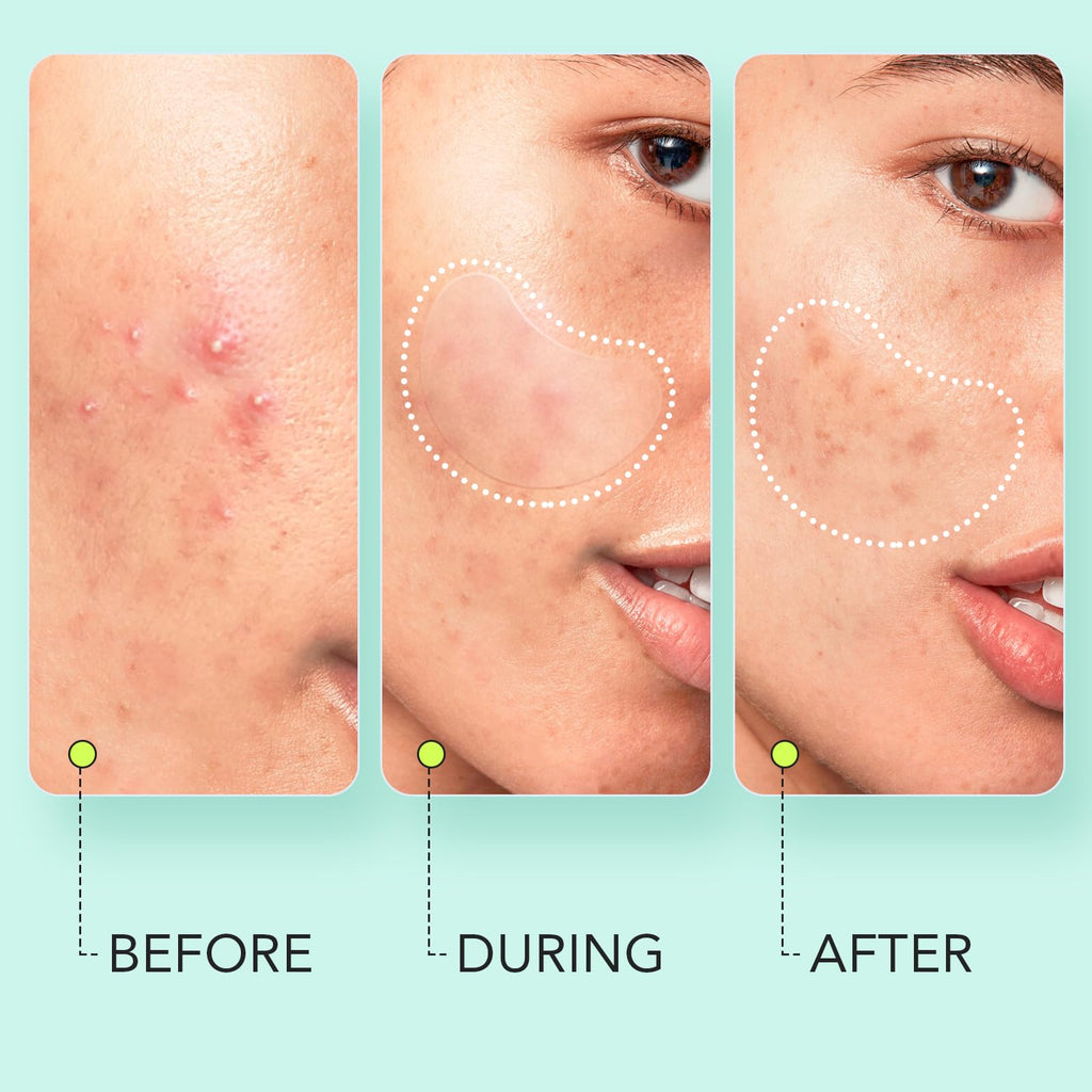 Large Pimple Patches for Face & Body, 7 Sizes 306 Counts