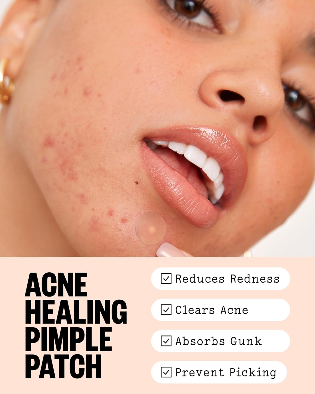 Acne Healing Dots Hydrocolloid Pimple Patches (20 count) | Fast Acting Acne Spot Treatment for Blemishes & Breakouts