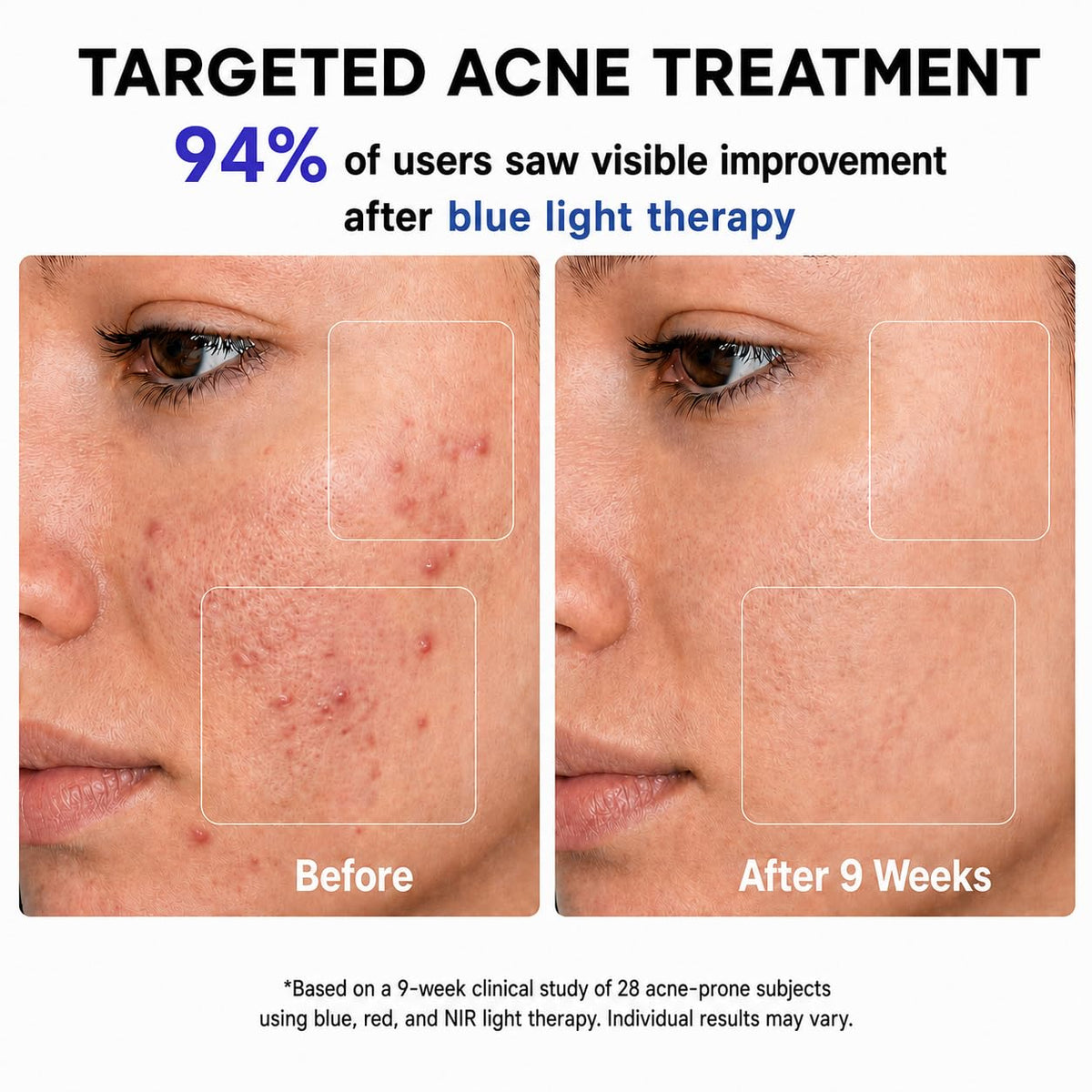 Red Light Therapy for Face, FDA-Cleared Blue Light Mask for Acne