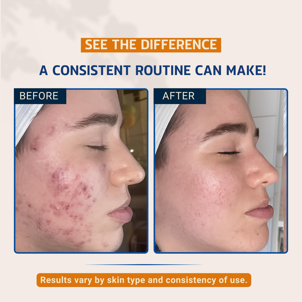 Acne Kit, 3 Step Skincare Set for Teens (3 count)