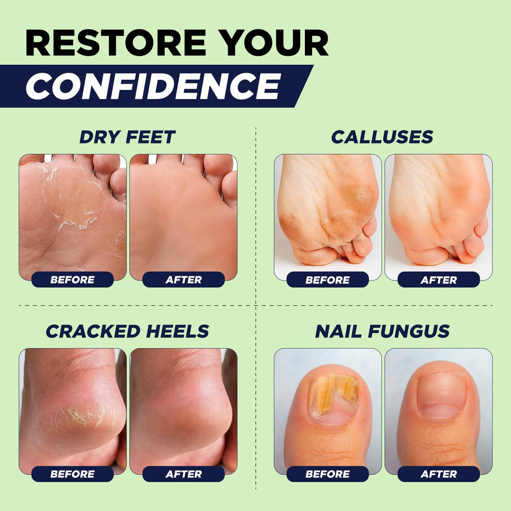 Foot Callus Remover Pedicure Set – Epsom Salt Foot Soak & Callus Remover Gel, Antifungal Cream and Feet Exfoliator
