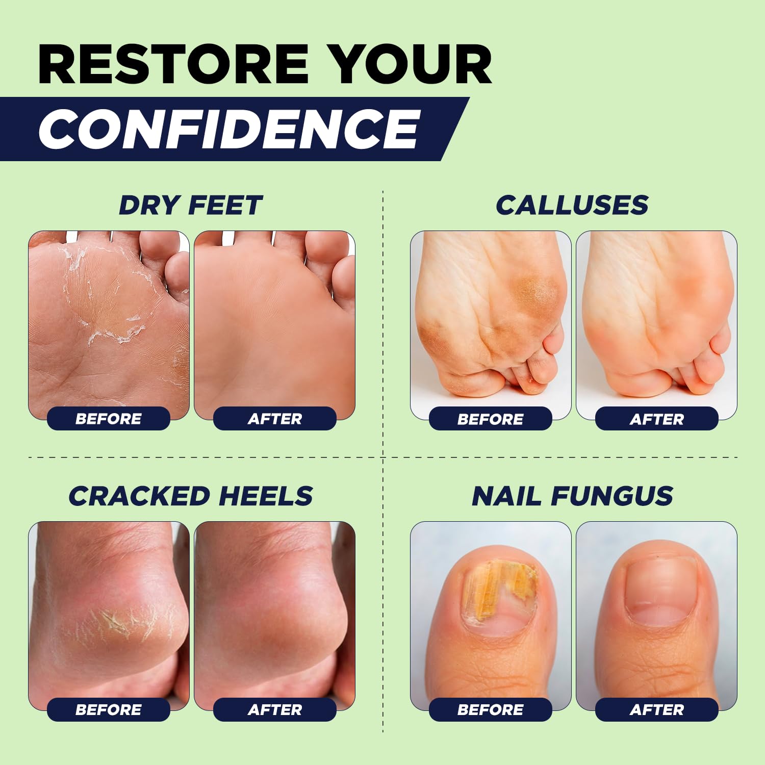 Foot Callus Remover Pedicure Set – Epsom Salt Foot Soak & Callus Remover Gel, Antifungal Cream and Feet Exfoliator