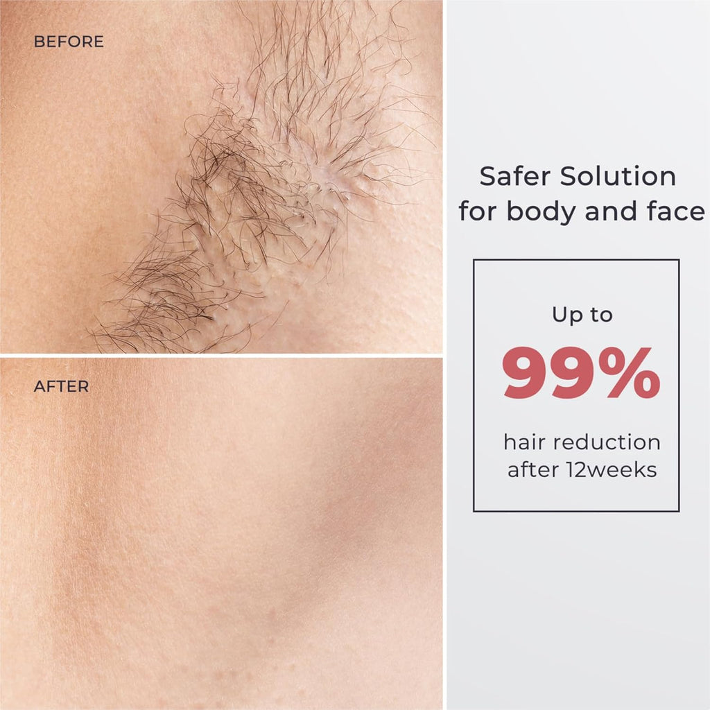 IPL Laser Hair Removal for Women and Men, Hair Removal with Ice-Cooling for Nearly Painless and Long-Lasting Result