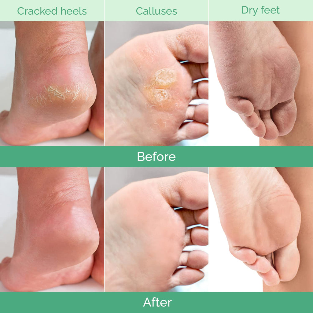 Foot Peeling Mask, Dermatologically Tested - 2 Pairs, Peach | Repairs Heels & Removes Dry Dead Skin for Baby Soft