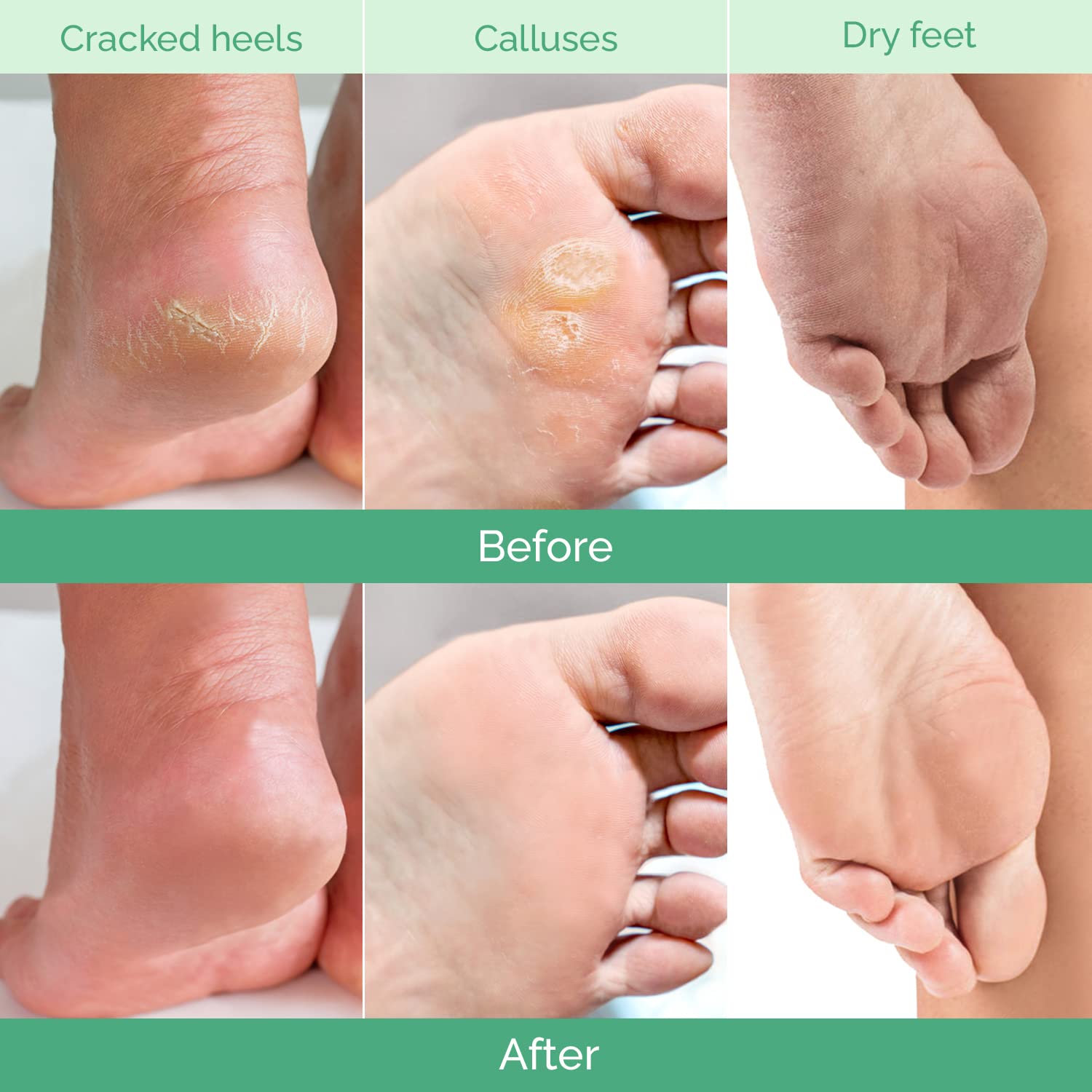 Foot Peeling Mask, Dermatologically Tested - 2 Pairs, Peach | Repairs Heels & Removes Dry Dead Skin for Baby Soft