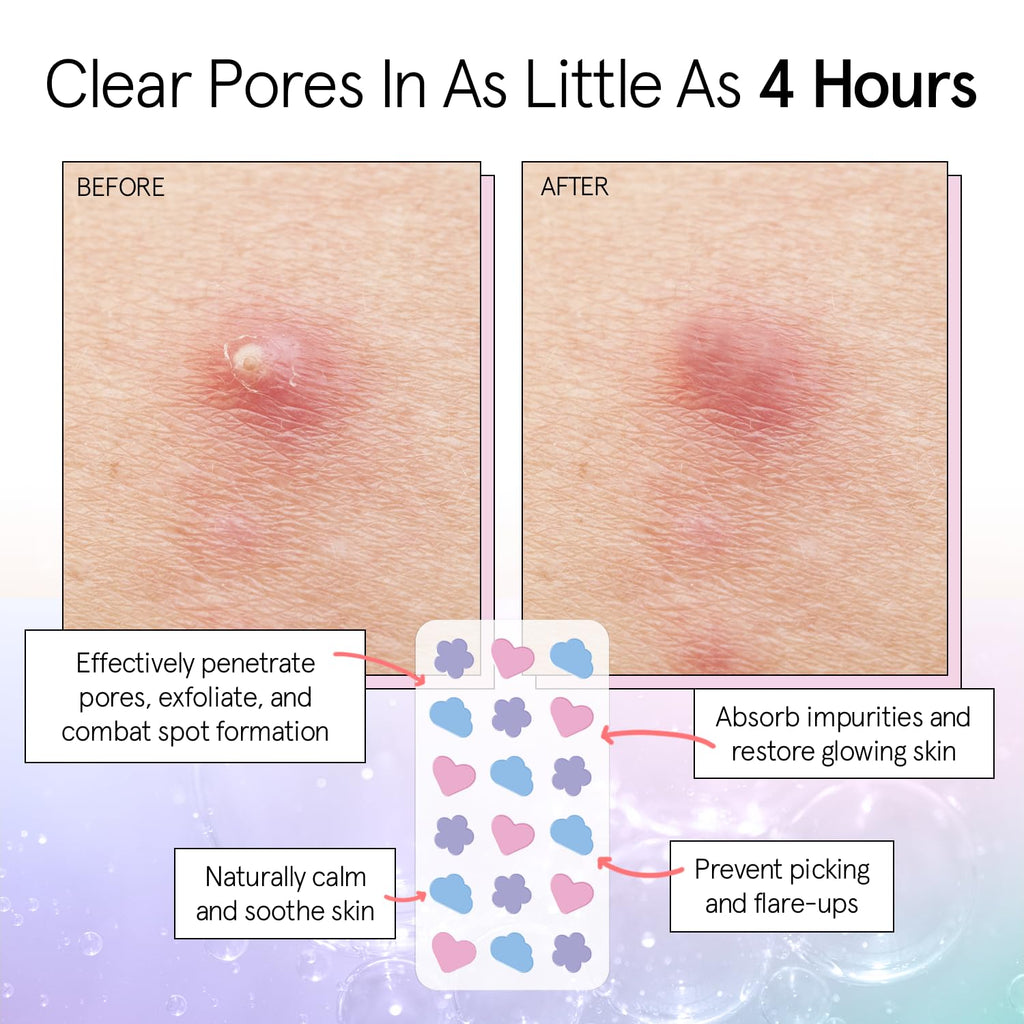 Award Winning Pore Strip - Pimple Patches for Face | Hydrocolloid Acne Patches - Absorbs Zits, Reduces Redness - Cute