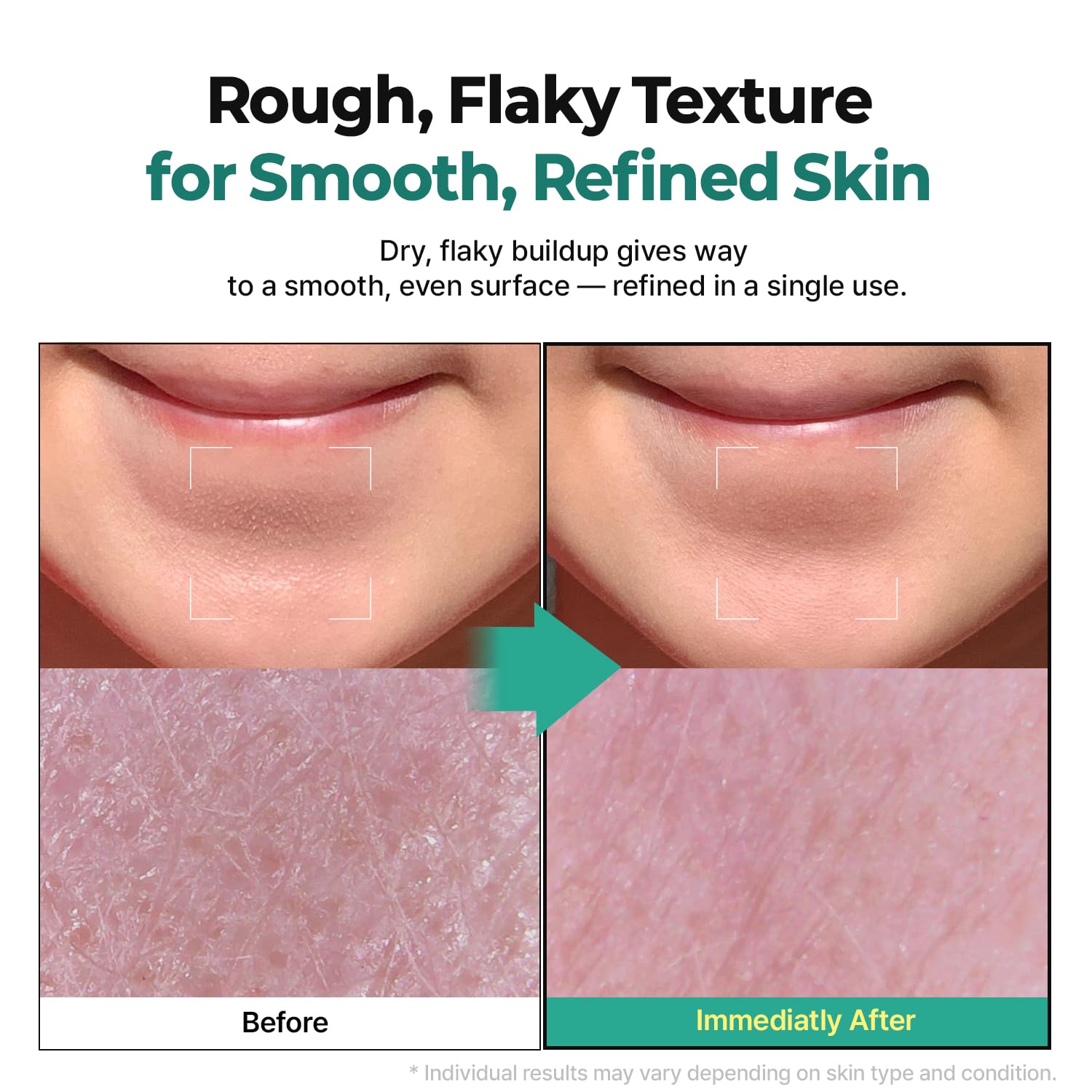 LHA Green Tea Exfoliating Aqua Peel Gel, Deep Pore Face Exfoliant, Gentle Facial Exfoliator, Dead Skin Remover