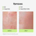 Exfoliating Salicylic Acid Toner for Face Exfoliator Pore Cleaner