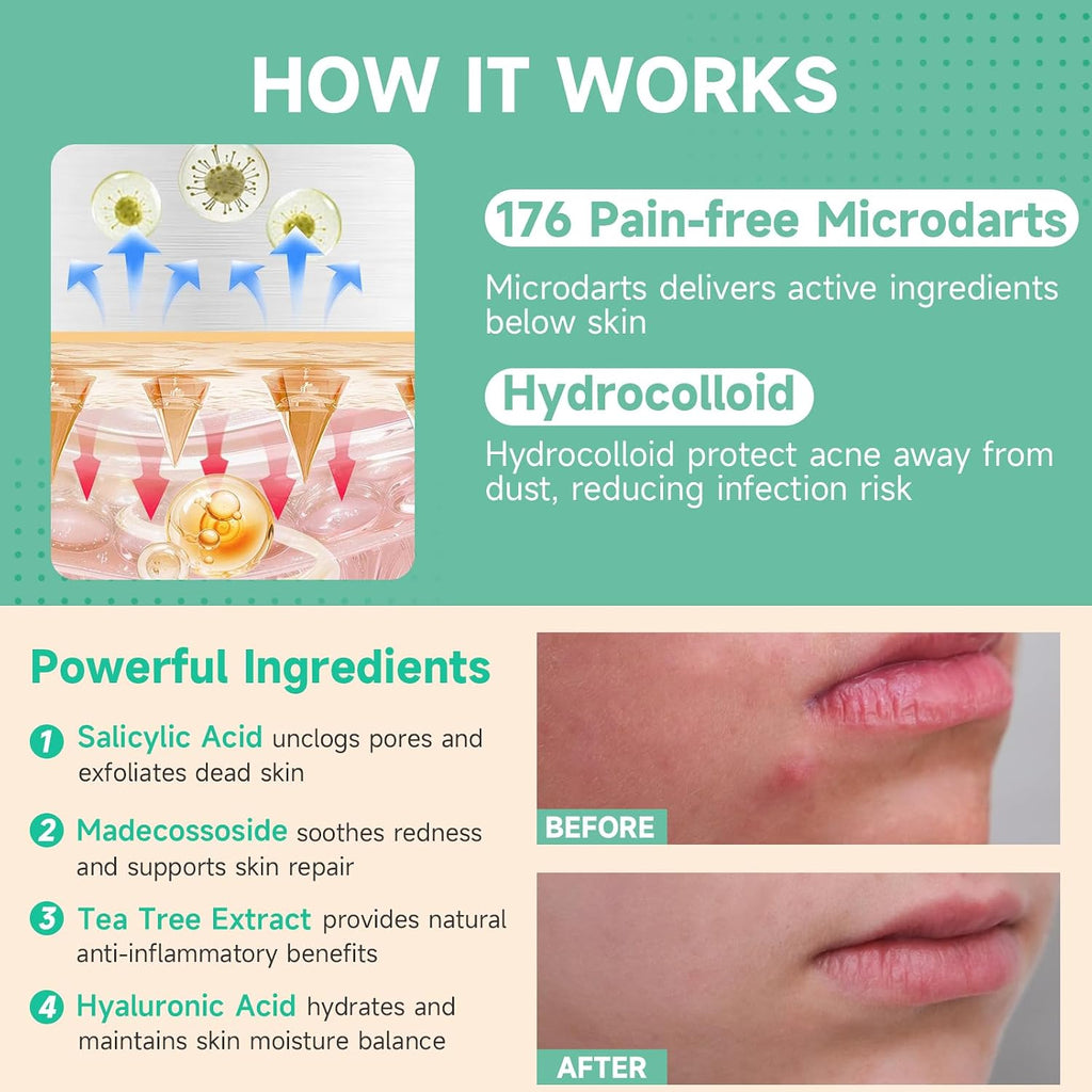 36-Count Microdart Pimple Patches, Hydrocolloid Acne Patches with Salicylic Acid & Madecossoside, Microdart Zit