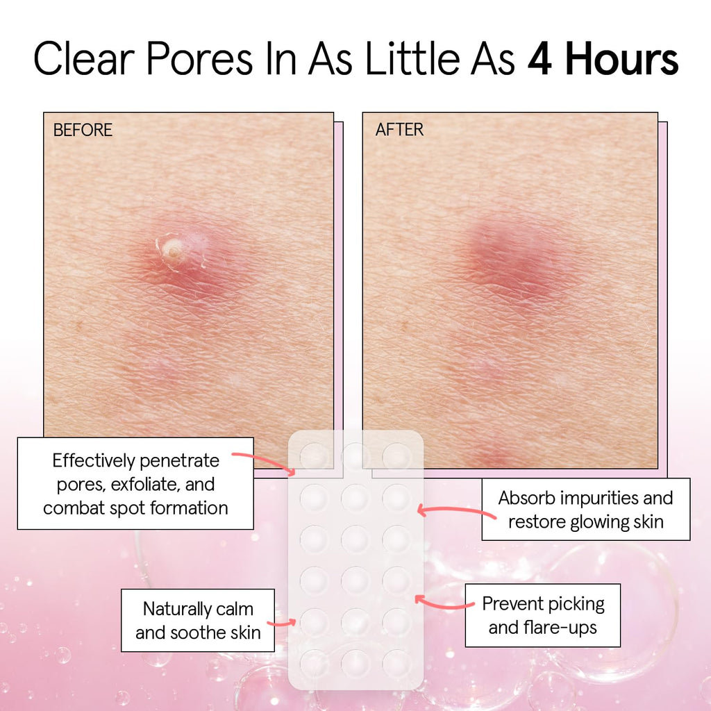 Award Winning Multi-Size Pimple Patches for Face