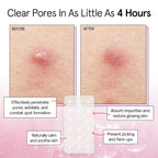 Award Winning Multi-Size Pimple Patches for Face