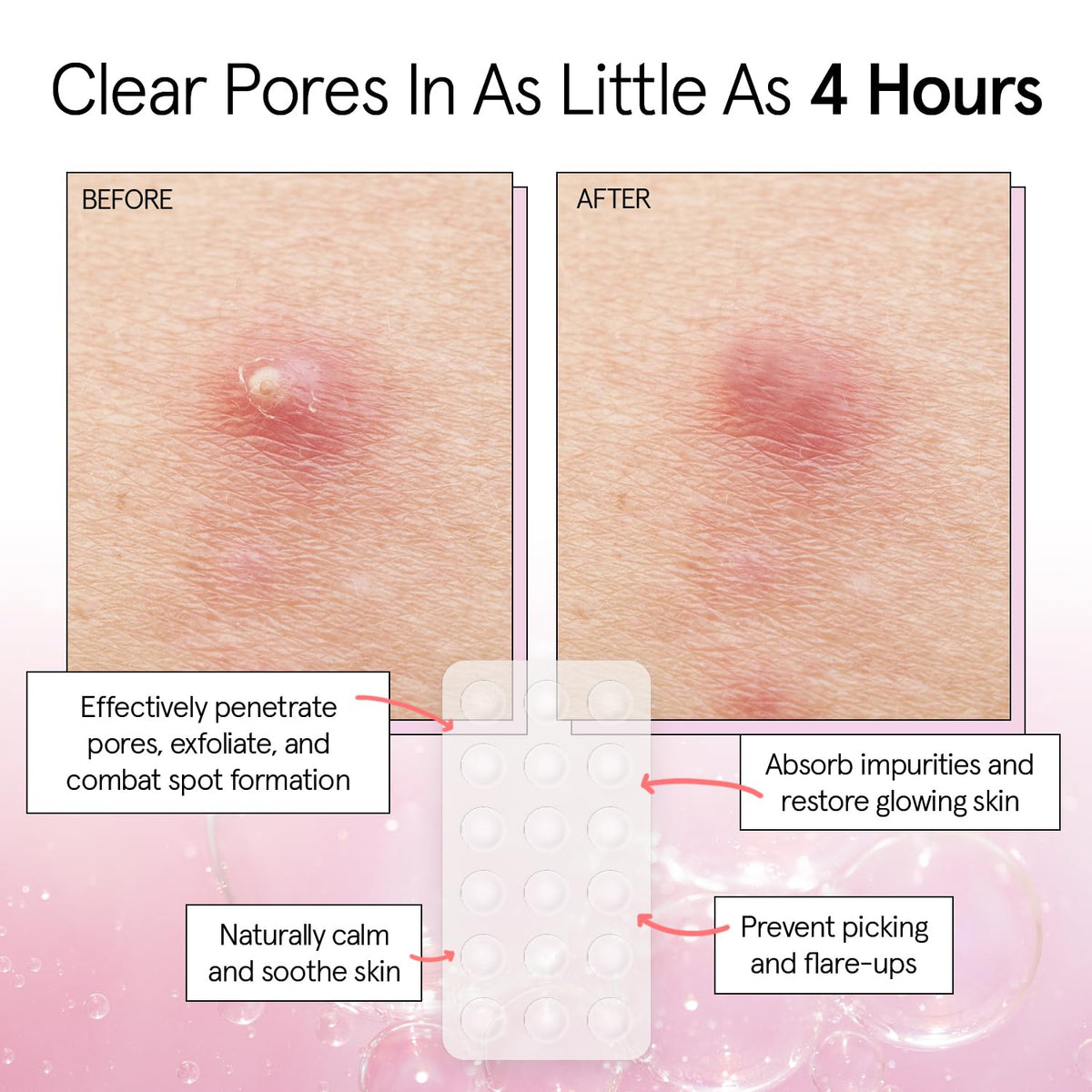 Award Winning Multi-Size Pimple Patches for Face