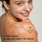 Large Hydrocolloid Pimple Patches for Breakout Areas, 30 Count