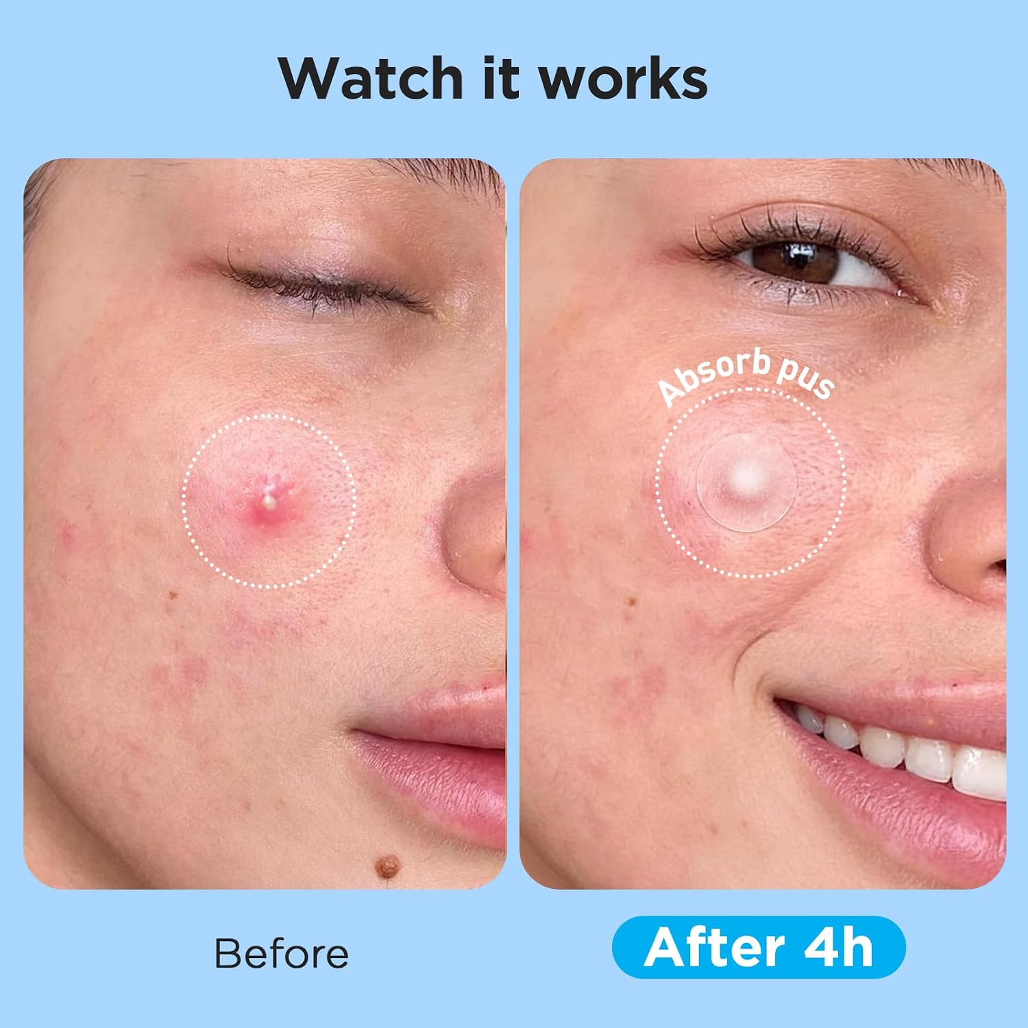 Pimple Patches for Face (504 Count), FSA Eligible Acne Patch Bulk, Zit Stickers 4 Sizes, Hydrocolloid Spot Stickers