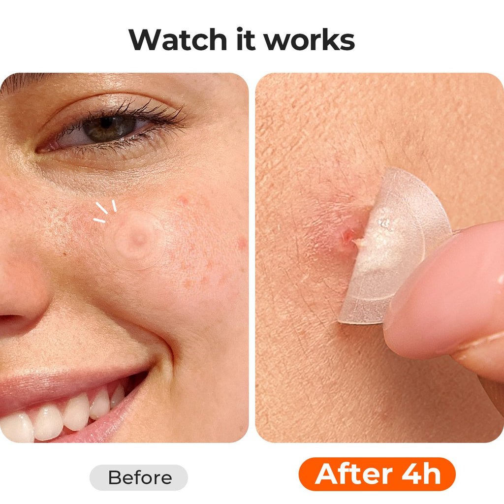 Ultra-Thin Invisible Pimple Patches for Teens & Makeup 168 Pcs