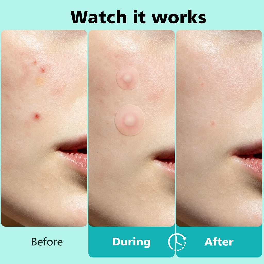 563 Count Pimple Patches - Hydrocolloid Acne Patches for Face & Body, Invisible Thin, Large & Small Sizes for