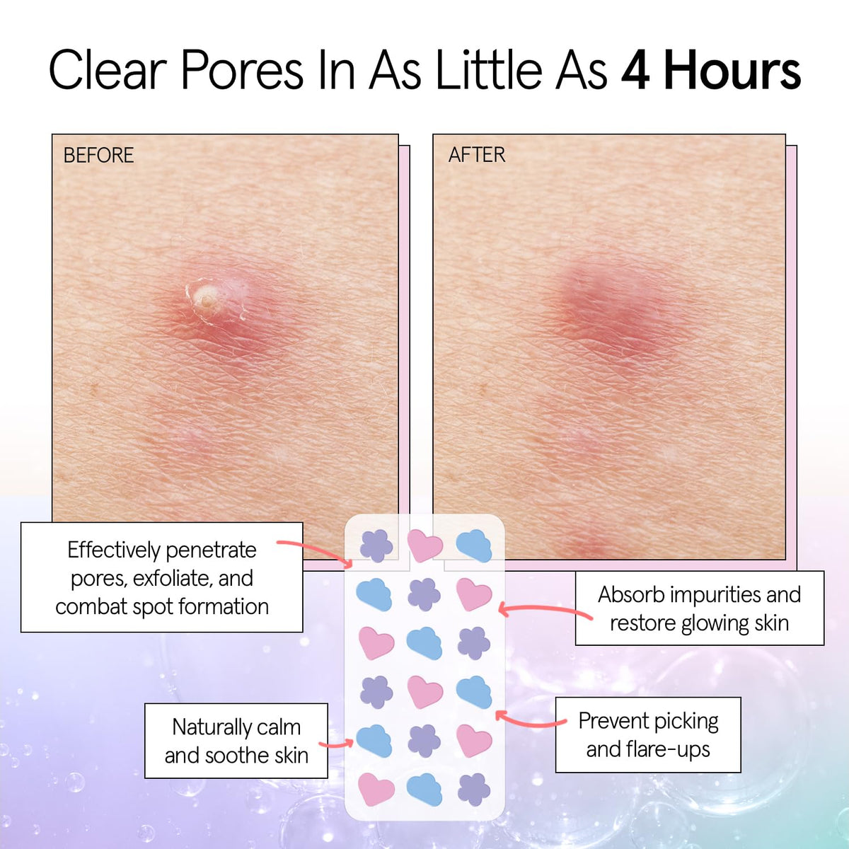 Award Winning Pimple Patches for Face -72 Pack Multishape