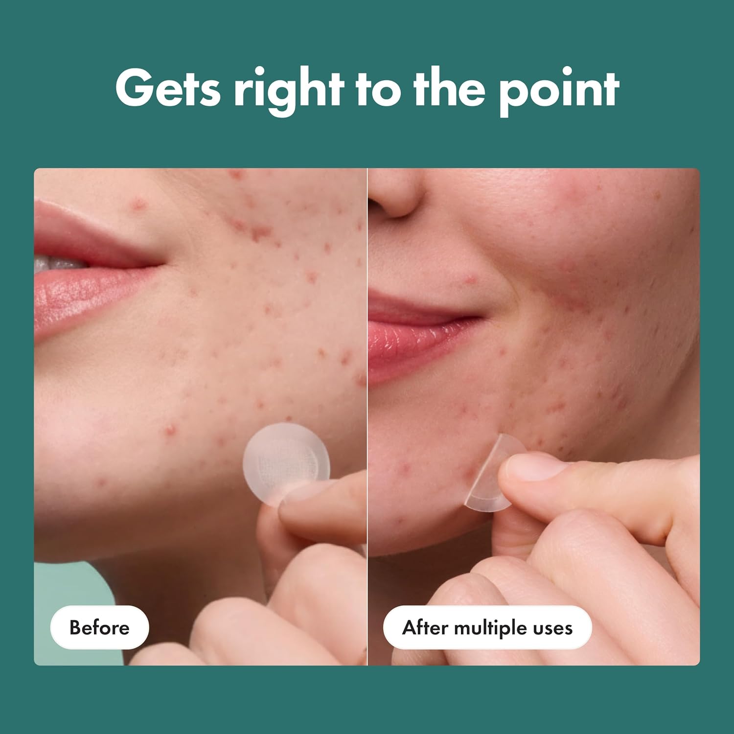 Hero Cosmetics Micropoint Acne Pimple Patches, 8 Ct | For Early Stage Zits & Hidden Blemishes; Hydrocolloid with