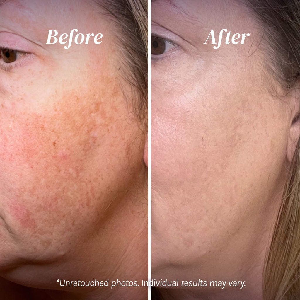 Dark Spot Corrector, Dark Spot Remover for Face