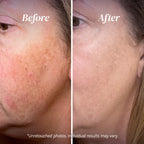 Dark Spot Corrector, Dark Spot Remover for Face