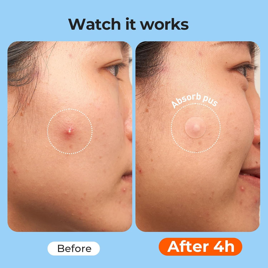 609 Count Pimple Patches for Face, Hydrocolloid Acne Patch Bulk, Acne Stickers for Covering Cheeks, Forehead, Chin