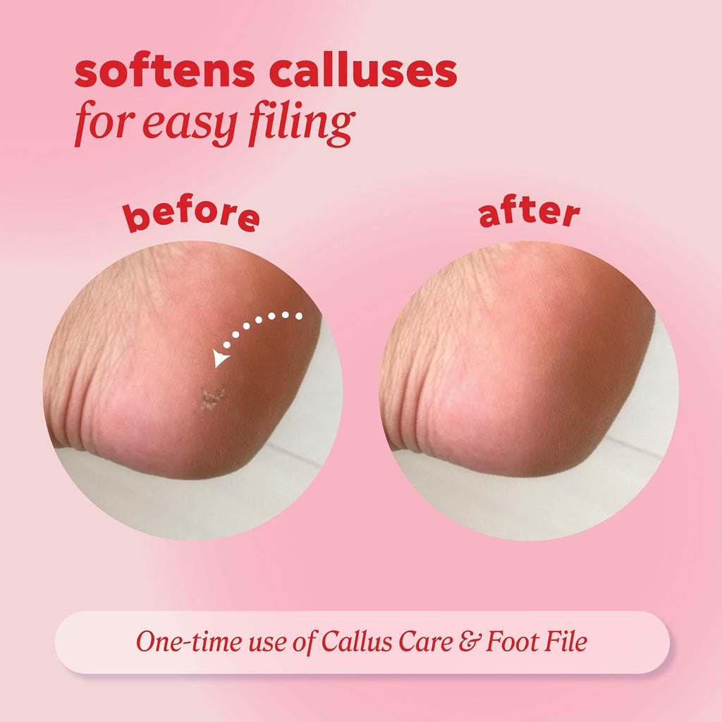 Callus and Corn Peeling Gel, 4 fl oz - Removes Unwanted Calluses in 3-5 Minutes, Hydrating and Softening Heel Callus