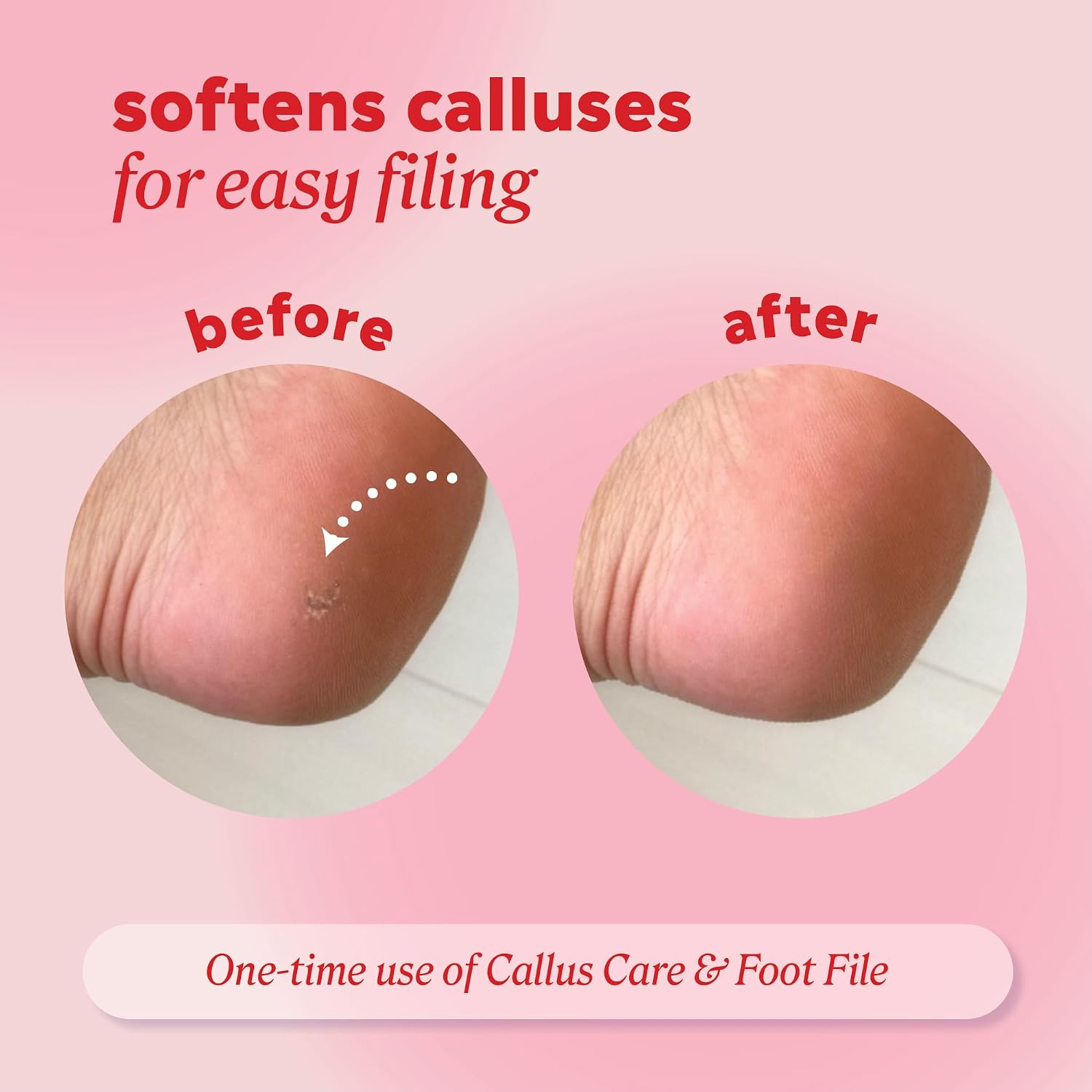 Callus and Corn Peeling Gel, 4 fl oz - Removes Unwanted Calluses in 3-5 Minutes, Hydrating and Softening Heel Callus