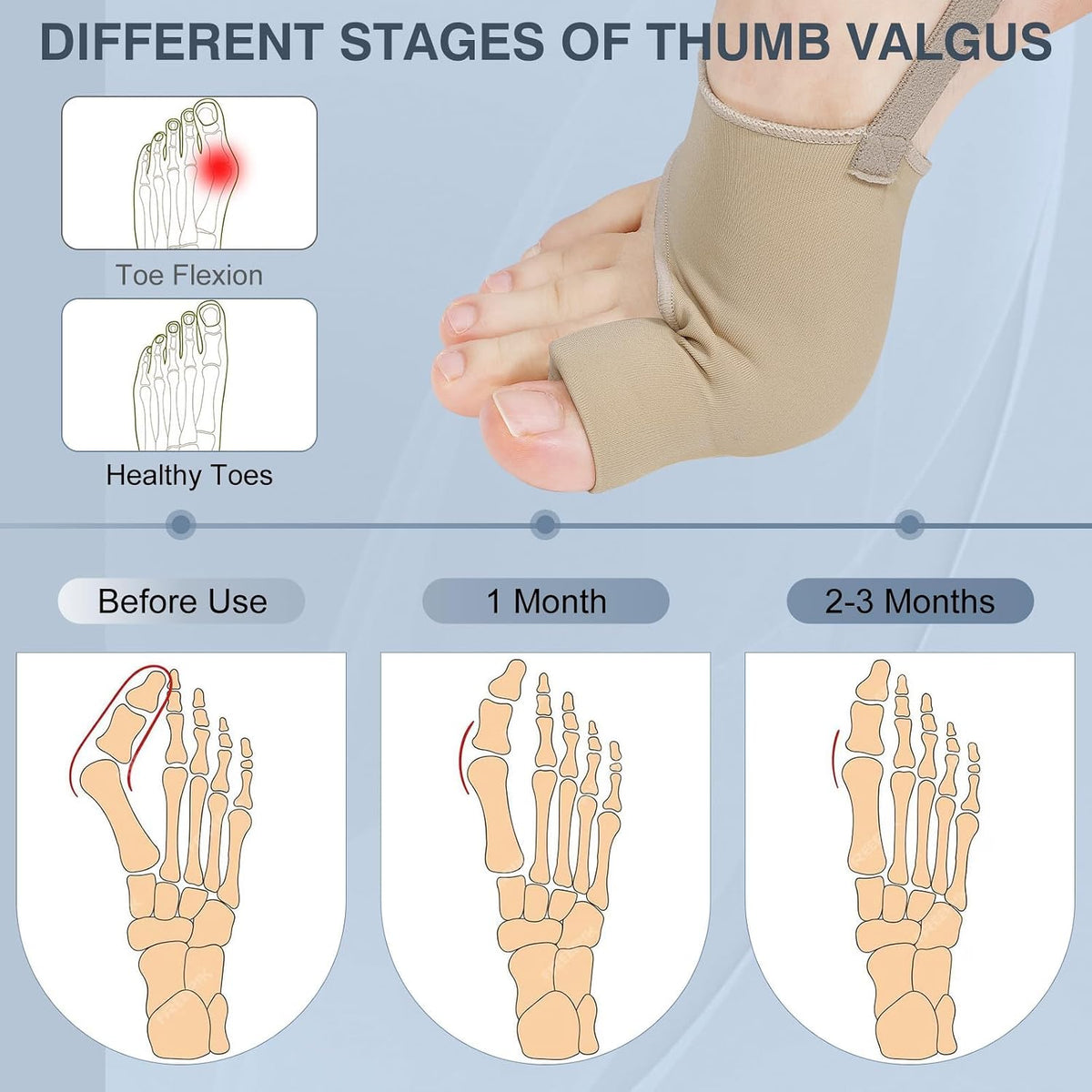 2PCS Bunion Corrector for Women & Men, Big Toe Straightener with Splint & Pads, Comfortable & Breathable for