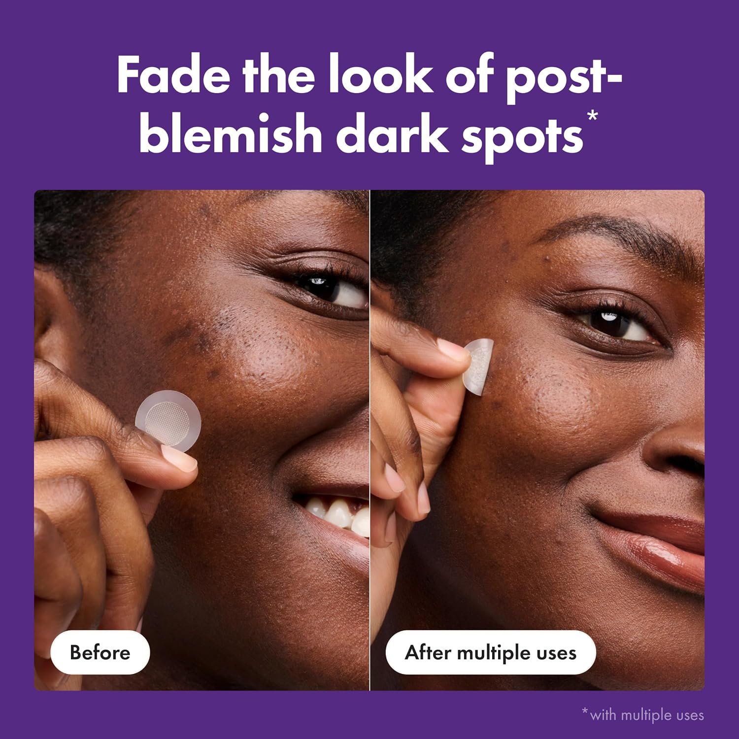 Hero Cosmetics for Dark Spots Post-Blemish Patch, 8 Ct | Acne Patch with 395 Micropoints, Formulated With Vitamin C