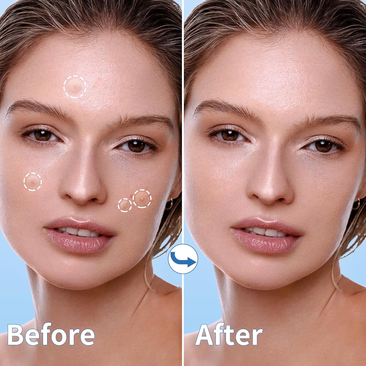 Pimple Patches for Face, 4 Size 300 Counts Acne Patches, Hydrocolloid Patches for Covering Zits and Blemishes, Spot