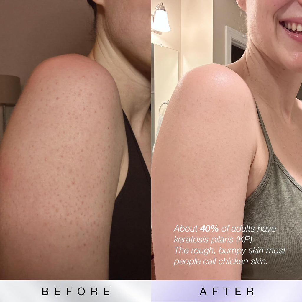 KP Bump Eraser Body Scrub, 10% AHAs + PHAs, Rough & Bumpy Skin