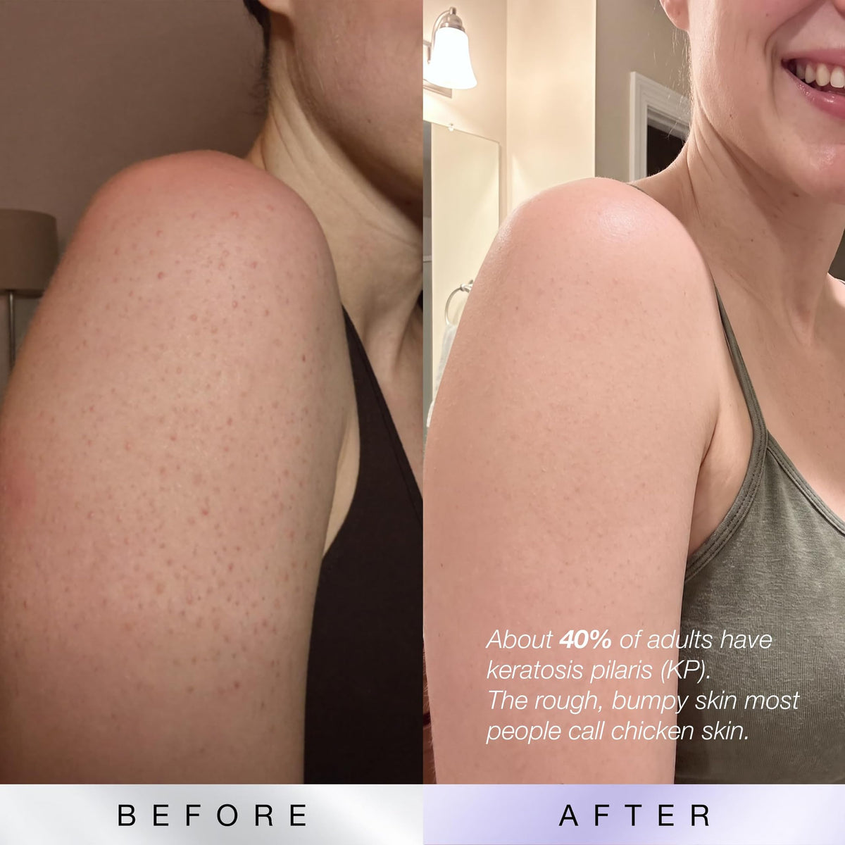 KP Bump Eraser Body Scrub, 10% AHAs + PHAs, Rough & Bumpy Skin