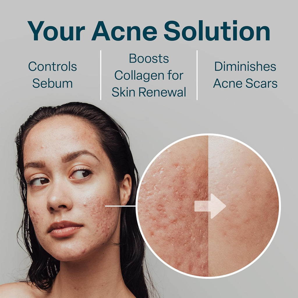 Salicylic & Glycolic Acid Acne Clearing Pads - 2% Salicylic & 10% Glycolic Acid - Exfoliating Pads for Acne, Bacne
