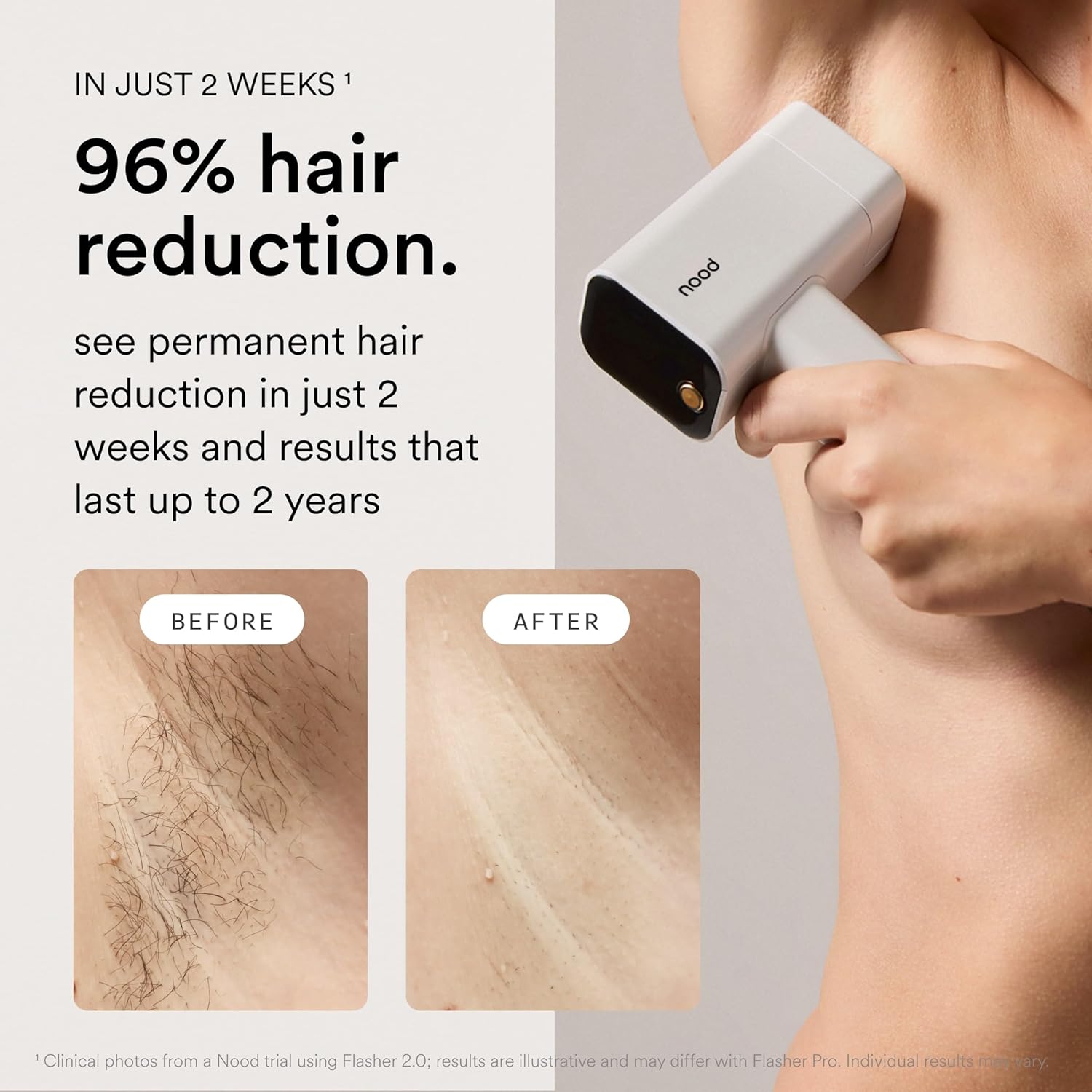 Flasher Pro | IPL Laser Hair Removal Device, Forbes Best Product 2026 | Clinical-Grade Permanent Results At Home
