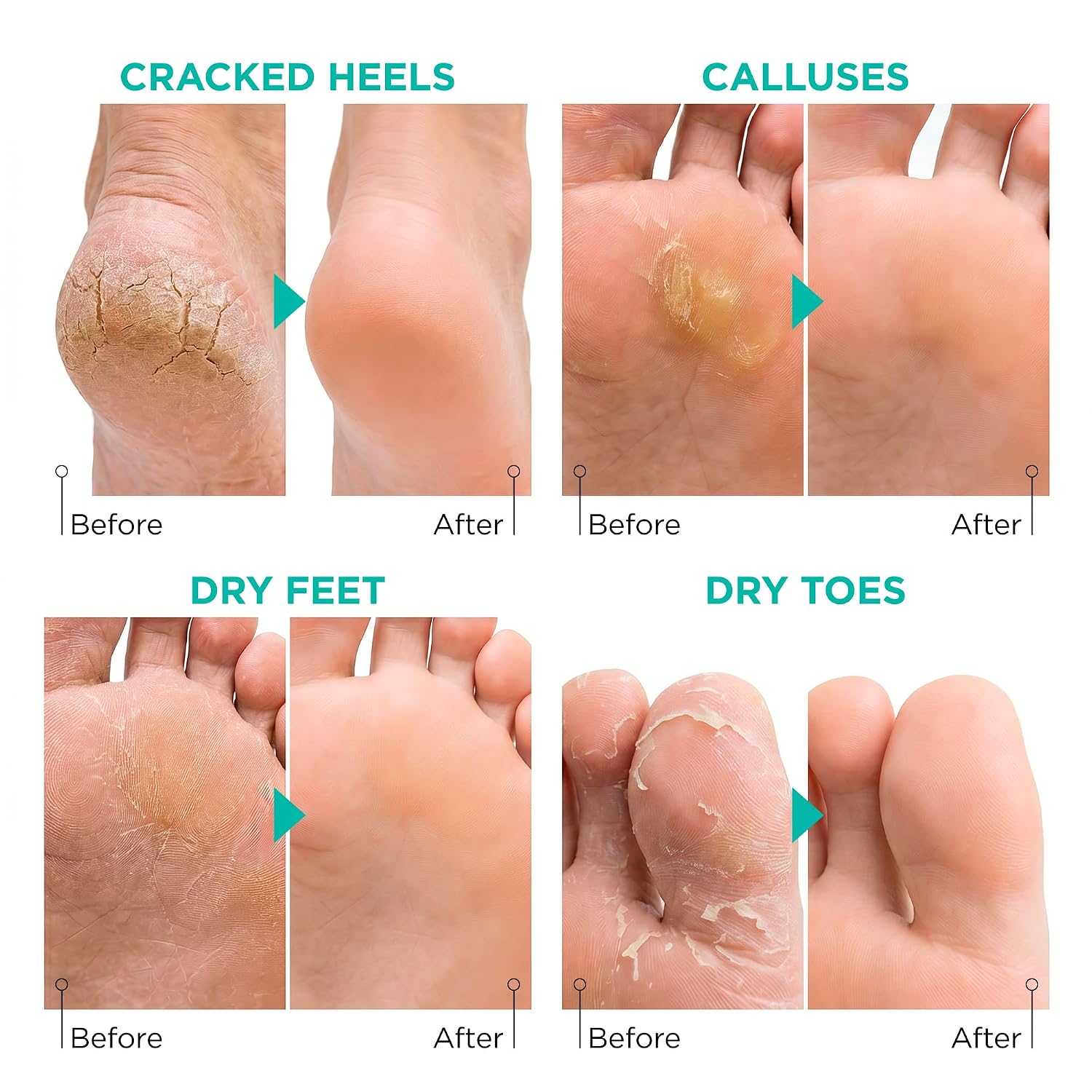 Foot Peel Mask for Dry Cracked Feet – 2 Pack Peeling Mask Removes Dead Skin and Calluses - Exfoliating for Soft Baby