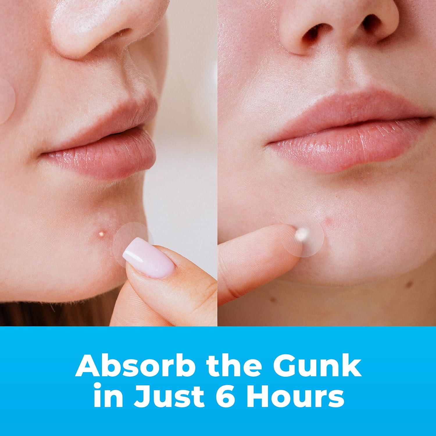 Pimple Patches for Face (120 Patches), Hydrocolloid Acne Patches with Tea Tree Oil, Pimple Patch Pimple Stickers
