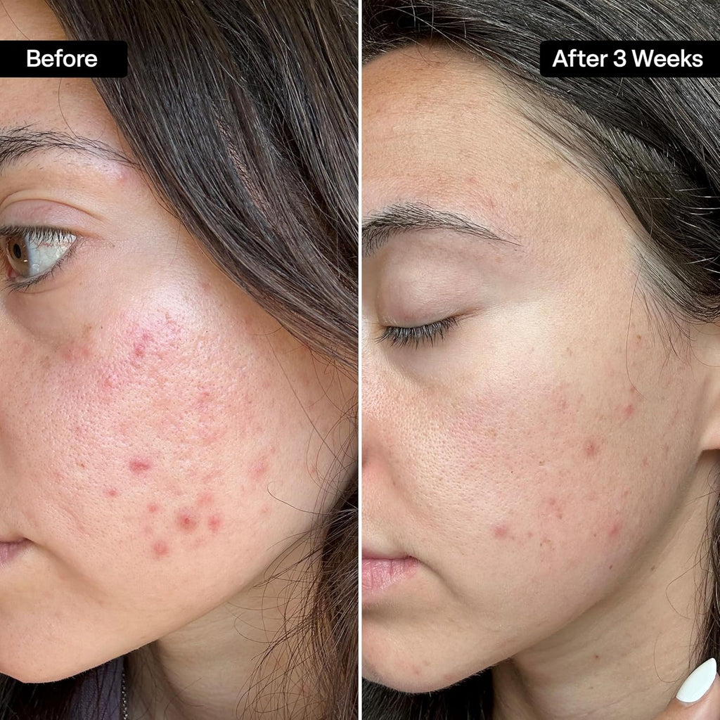 Salicylic & Glycolic Acid Acne Clearing Pads - 2% Salicylic & 10% Glycolic Acid - Exfoliating Pads for Acne, Bacne